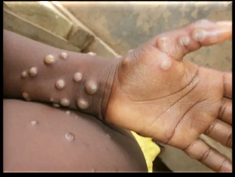 Mpox impacting a broader demographic, warns Lancet report