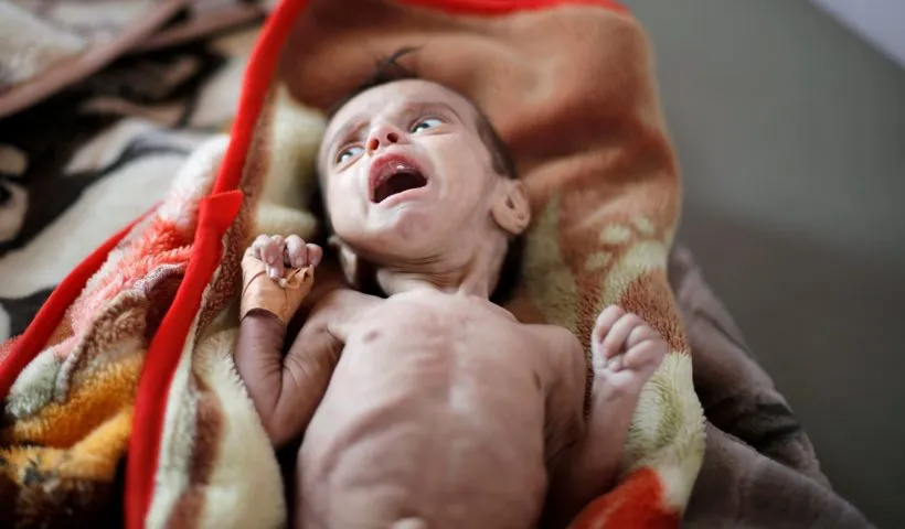 Malnutrition is 'crisis inside the crisis' in Yemen: NGO